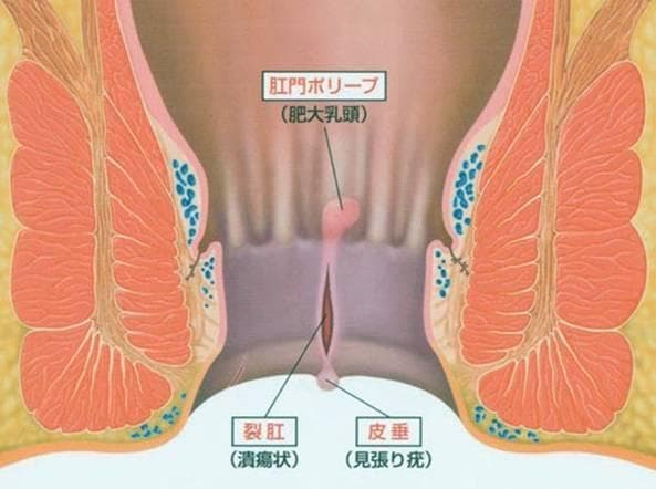 小儿肛裂的若干问题