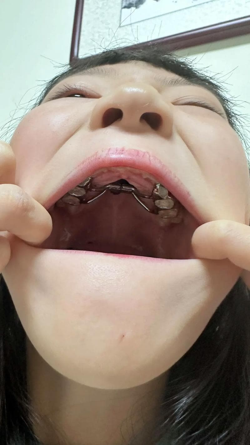 牙齿掉落怎么办？应急处理与预防全攻略