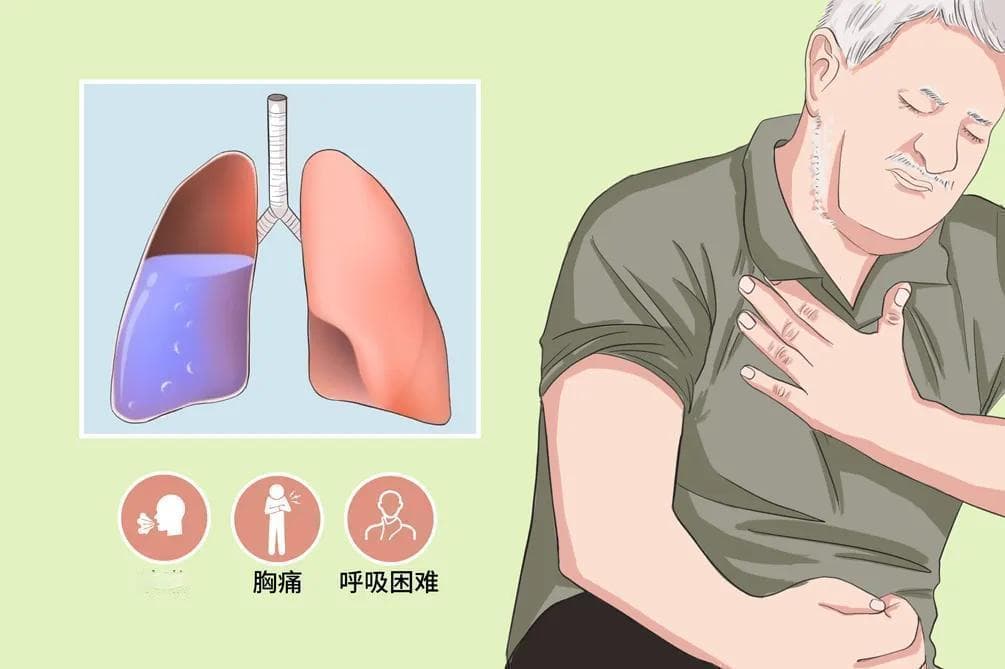 专业解析胸腔积液治疗：七类方法及临床应用