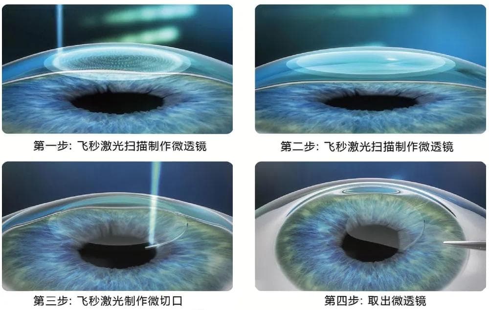 近视手术常见问题