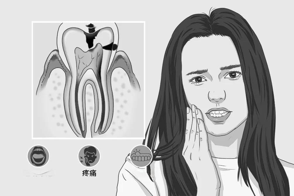 慢性根尖周炎：病因、症状、治疗与预防全解析