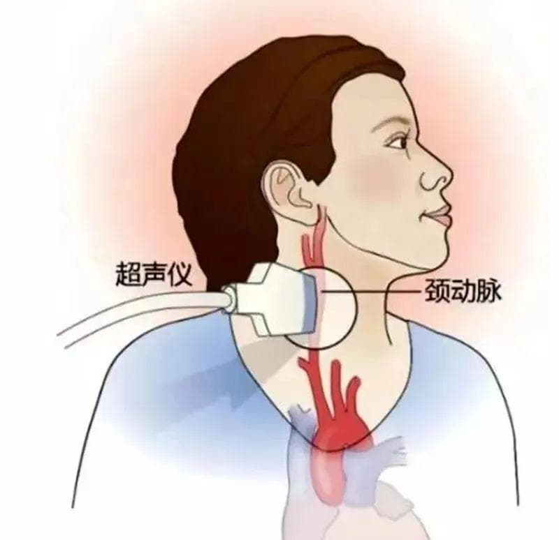 “医”探究竟—关爱您的“颈动脉”