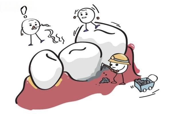 如何缓解牙结石的形成？正确刷牙/饮食合理/定期洁牙/定期检查等