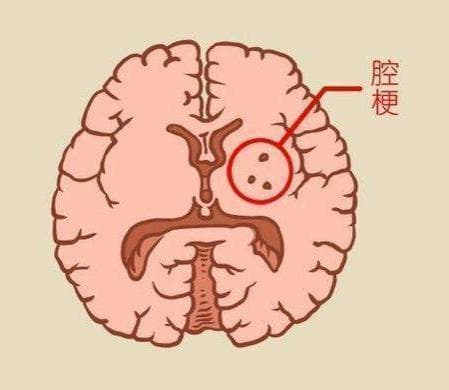 腔隙性脑梗死是中风吗？