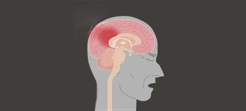 颅脑损伤的临床表现及如何预防