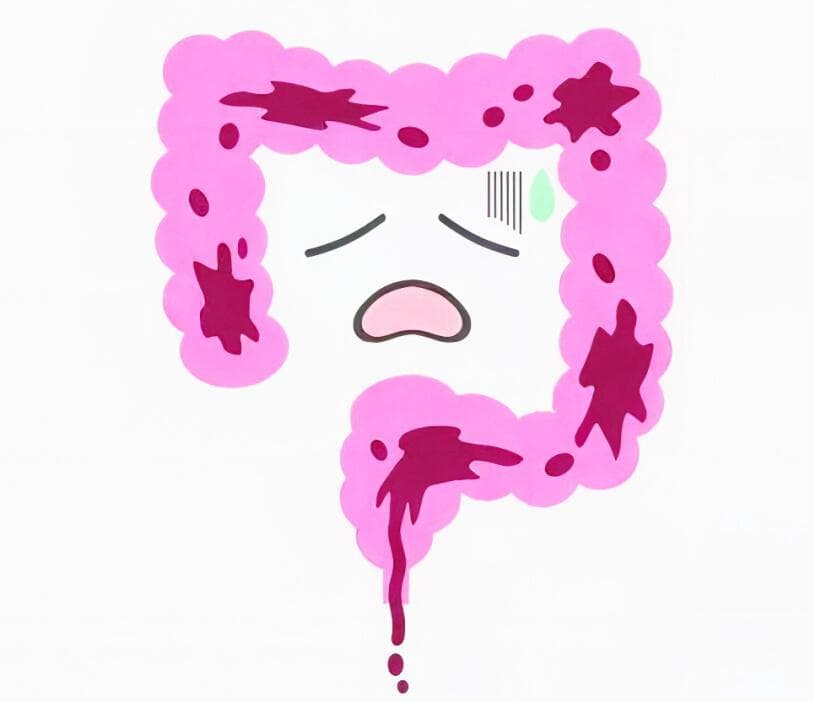 肠易激综合征（IBS）的识别和有效管理