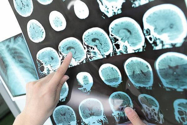 怎么判断脑梗是否严重