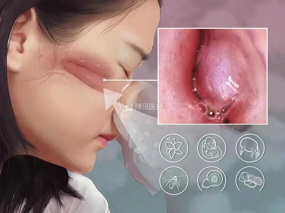 【朝医科普】过敏性鼻炎认识与防护
