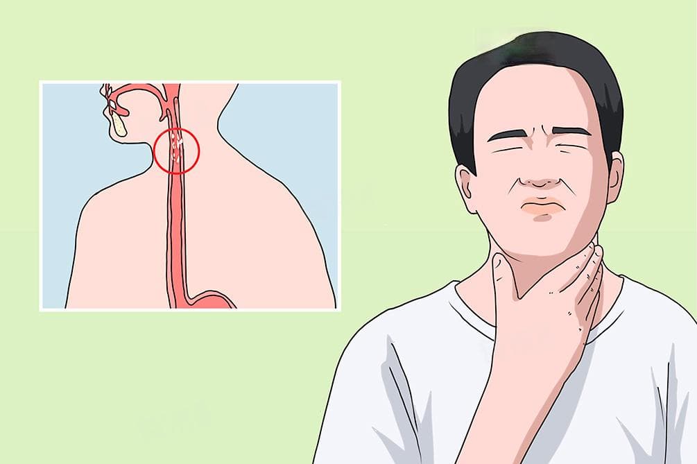 食管白斑是什么病？病因、症状、诊断与治疗全解析
