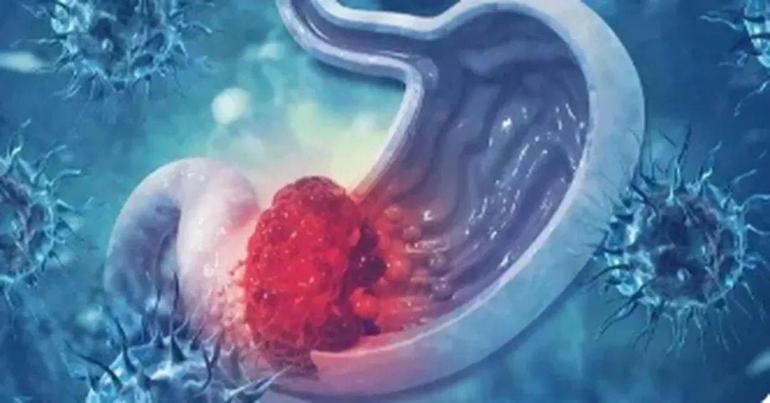 独特免疫景观！苏州大学陈卫昌教授团队：新的胃癌生物标志物