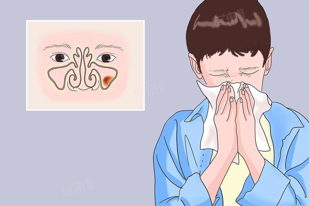 左侧上颌窦黏膜下囊肿是什么意思，怎么治疗