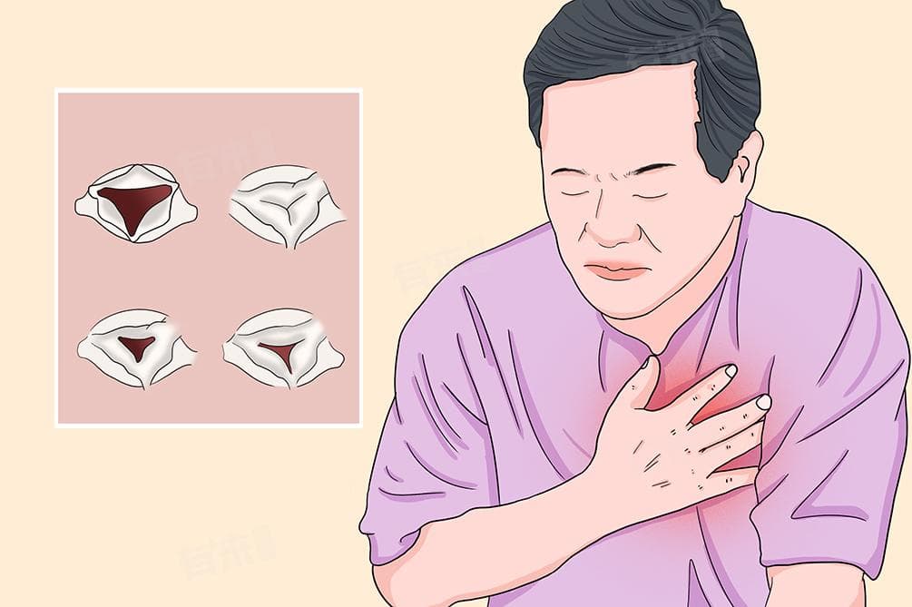 心脏瓣膜病的治疗
