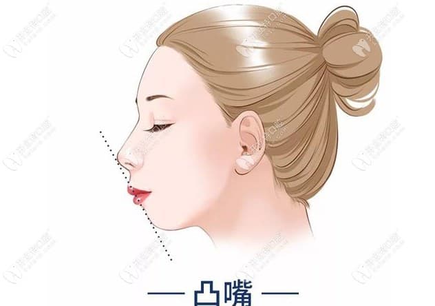 门牙太大外凸怎么矫正?网上说的自然方法改善嘴凸不可信