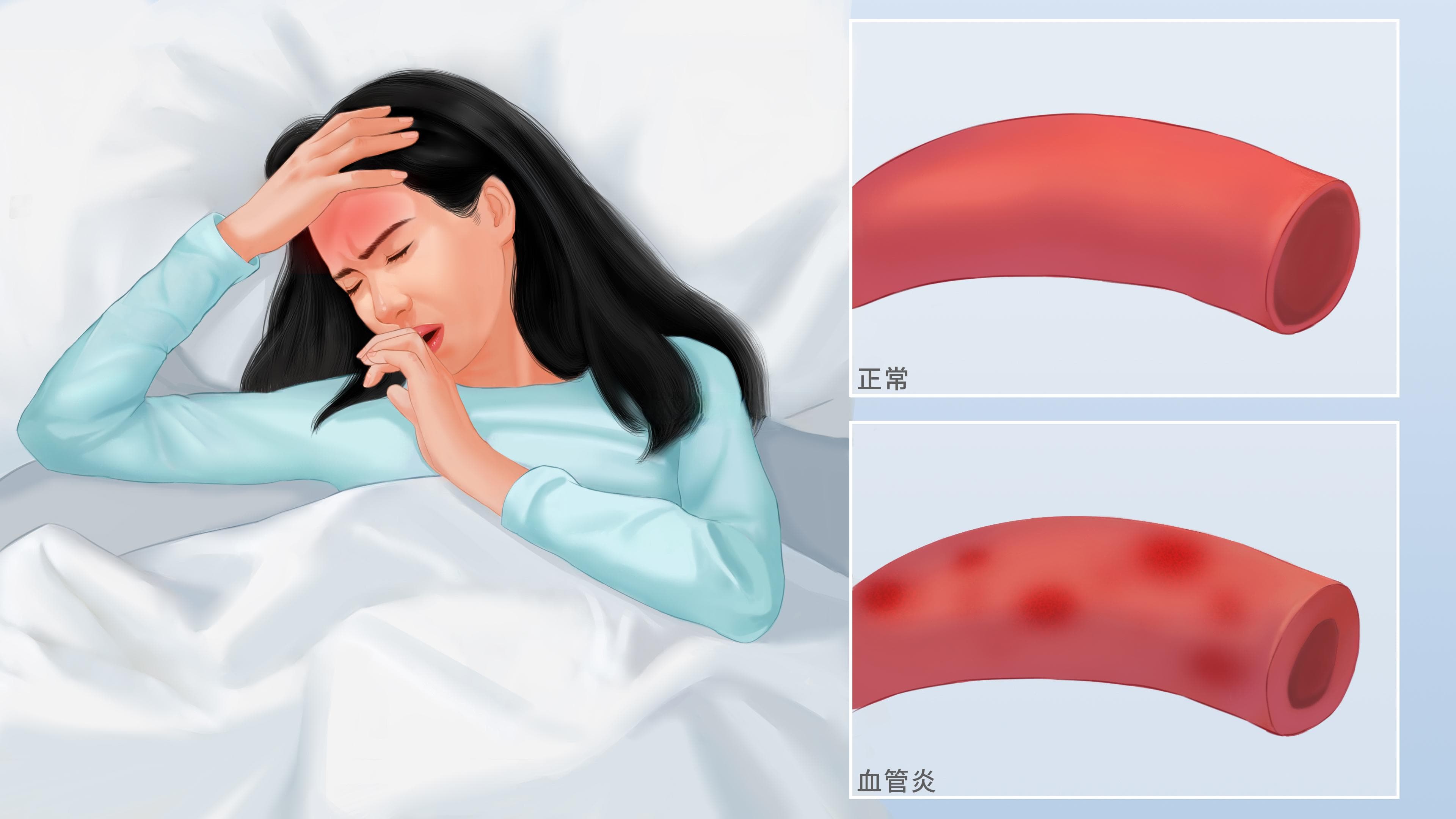 血管炎：一种累及多个系统的自身免疫性疾病