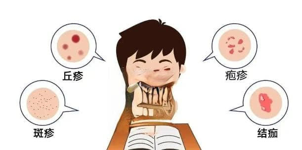 水痘大揭秘：别让错误认知耽误健康防护