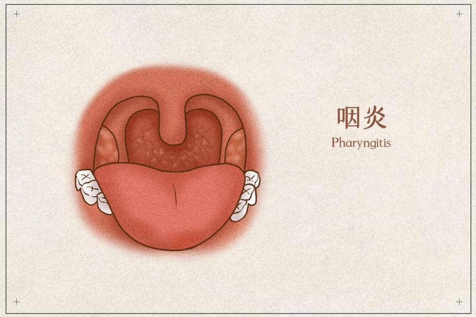 咽炎来袭，如何应对？医生提醒：做好8点预防，守护咽喉健康无忧