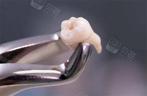 多位网友经验分享：拔牙有必要去大医院吗？拔牙是医院好还是牙科诊所好？