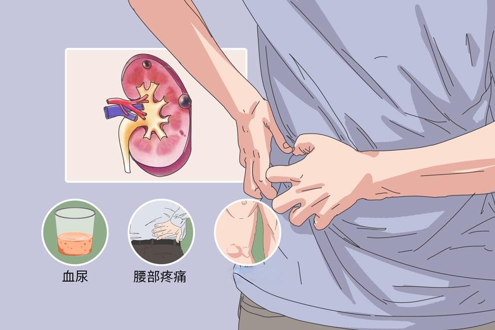 单纯性肾囊肿