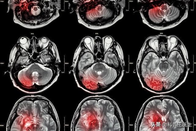 中西医结合：脑梗死偏瘫康复的“双保险”策略