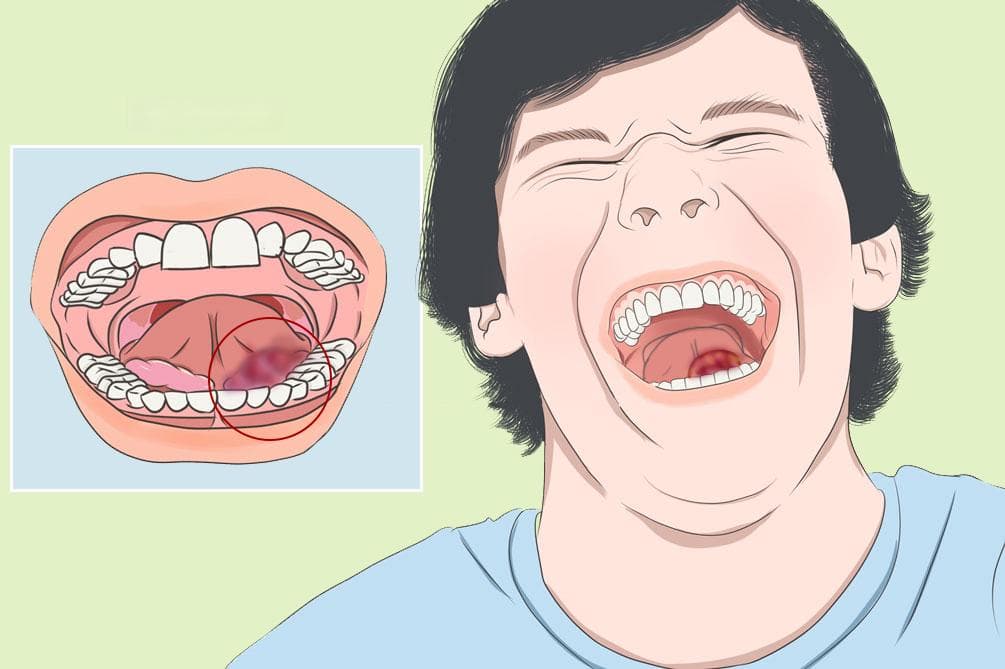 舌下腺囊肿：病因、症状、诊断与治疗全解析