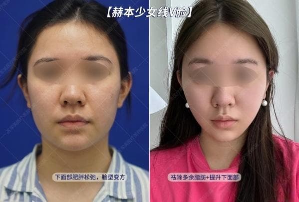 面部发腮分4种，看看你的是哪一种？