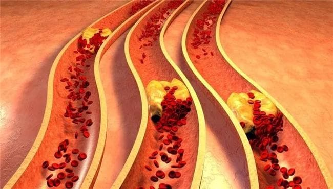 高血脂如何科学管理？阿托伐他汀钙片降血脂、防复发效果显著