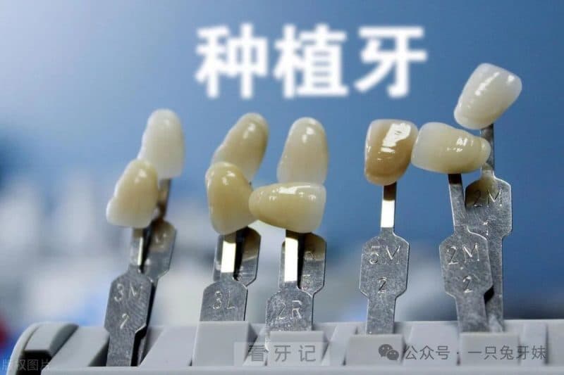 专业医生建议：如何选择适合自己的种植牙