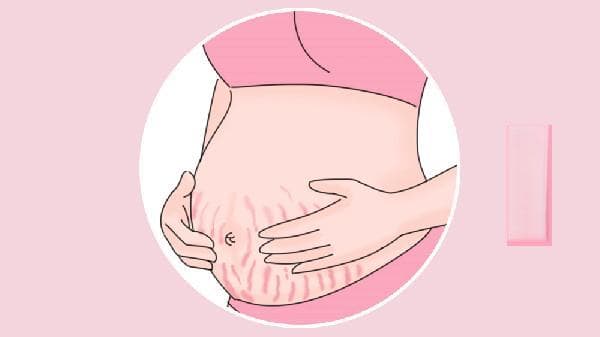 孕期如何防止妊娠纹产生