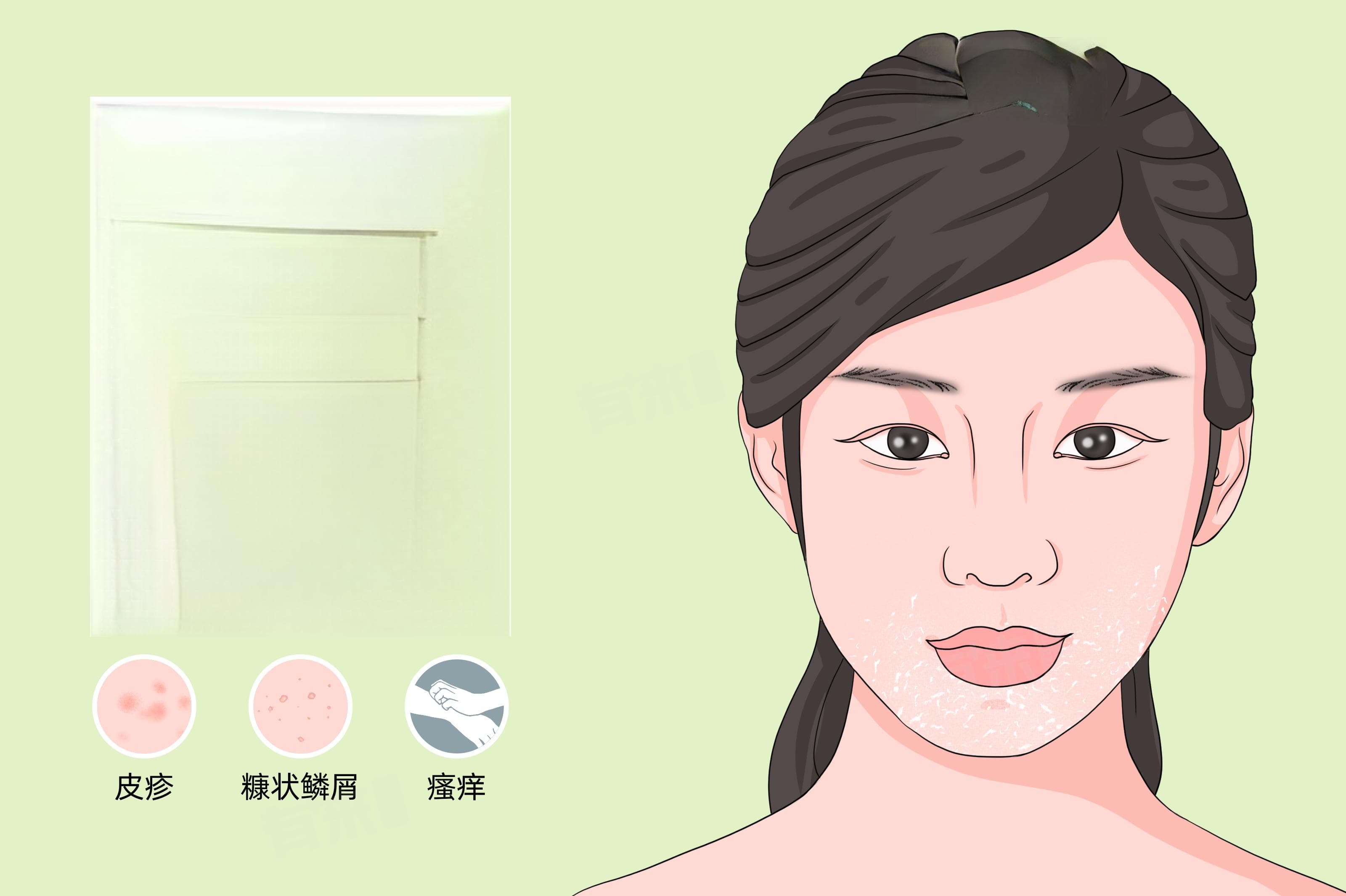脸痒干燥发红发痒怎么办