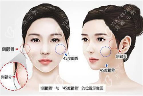 颧骨内推两年后脸必定下垂是真的还是假的？内推作用明显吗？
