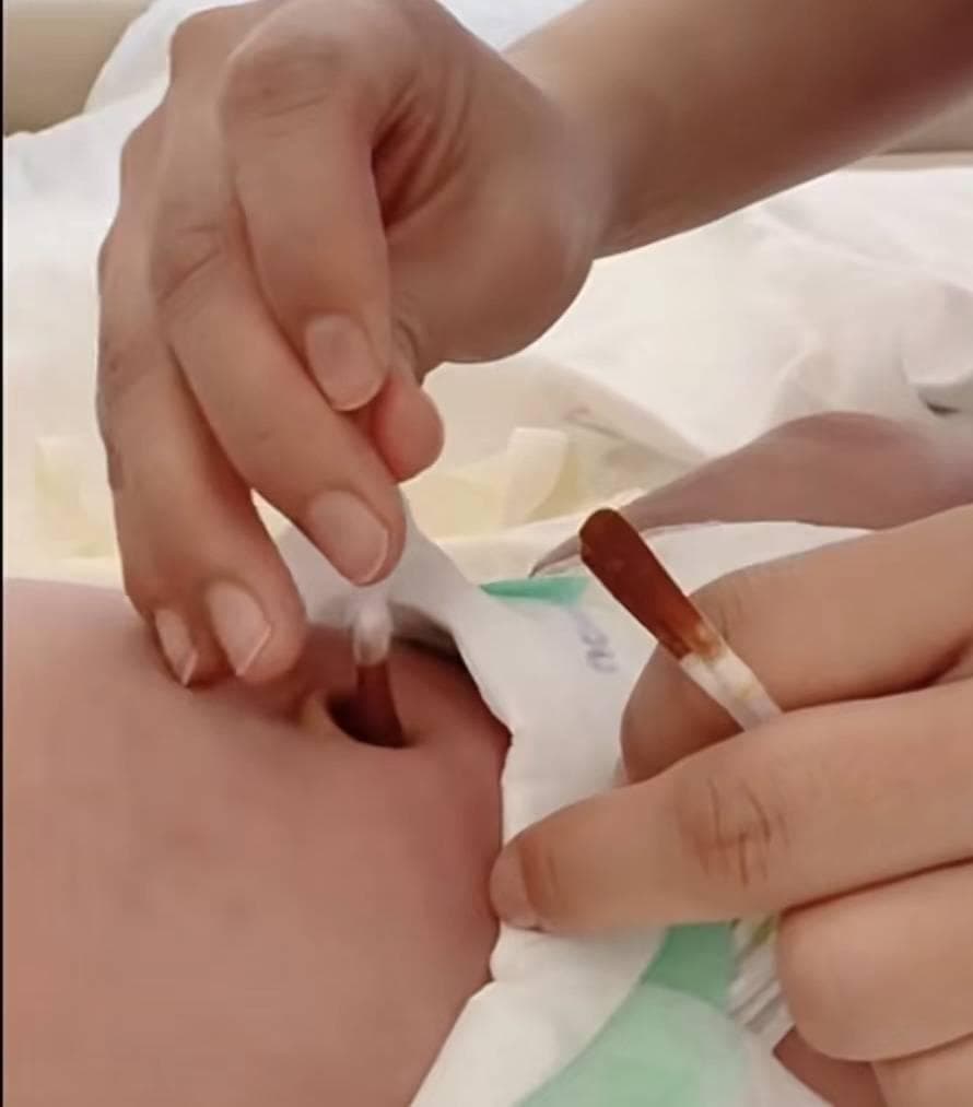 新生儿脐带护理指南：精心守护，健康成长起点！
