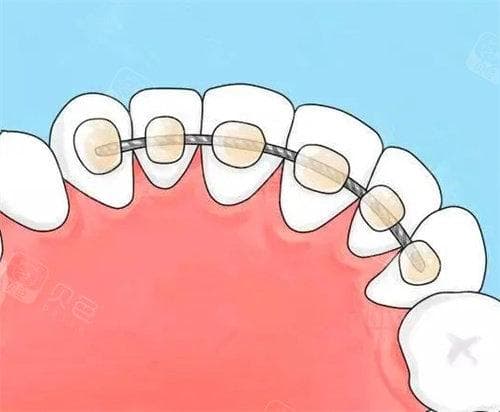 超多人都被医生一句:需要终生佩戴保持器吓退,那什么情况下要终生佩戴保持器