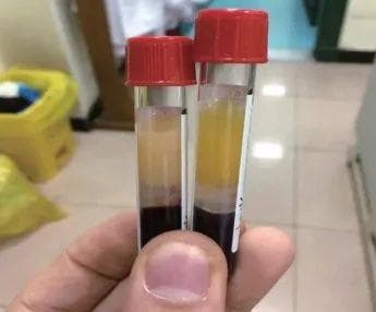 抽出来的血像奶茶或牛奶？高脂血症患者应该这么吃饭