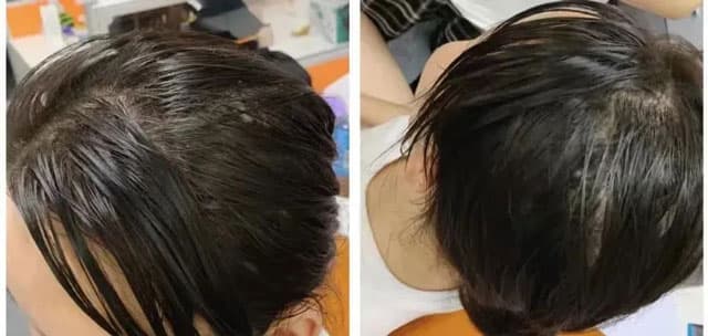 头发油腻，出现头屑、脱发是什么原因?