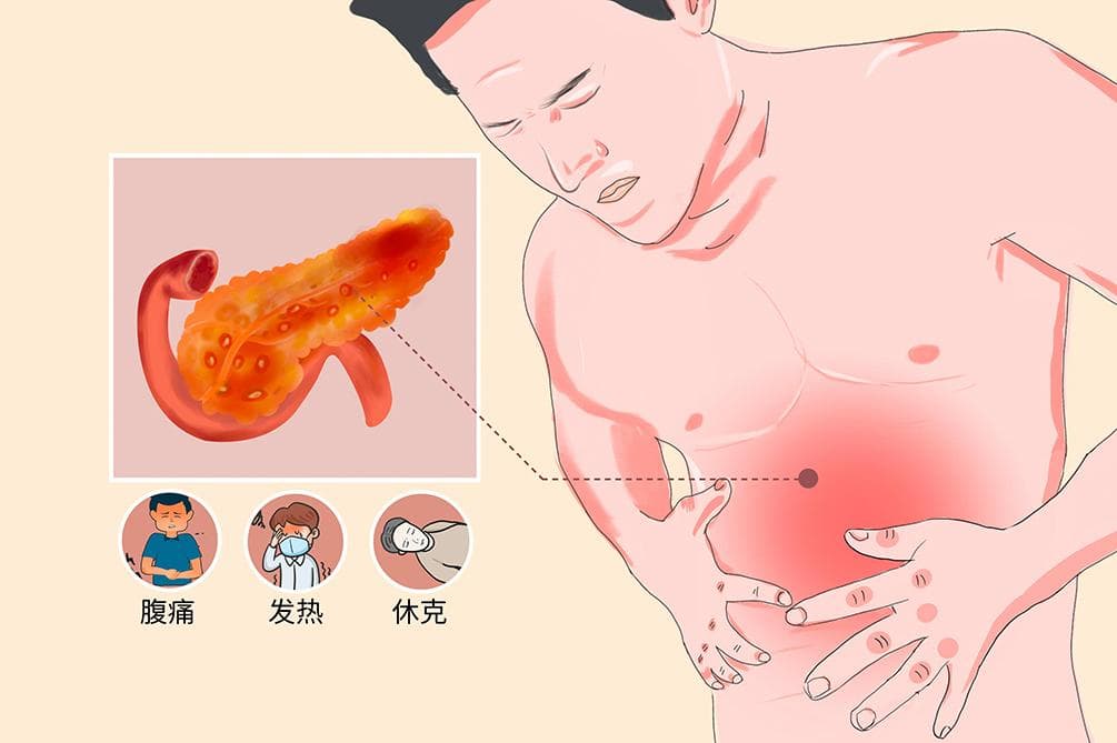 急性胰腺炎住院几天可以出院