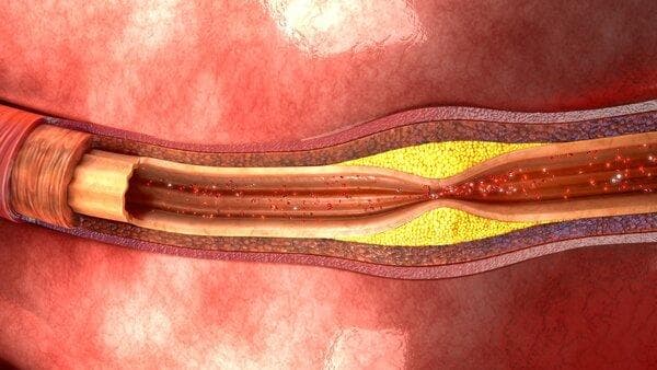 40岁得了腹主动脉管狭窄怎么办？病因与治疗全解析