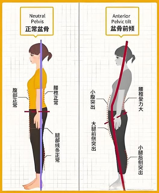 骨盆前倾：成因、评估、危害及矫正训练全解析