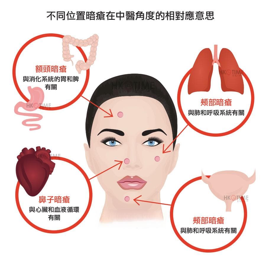 解讀暗瘡位置，一文了解原因和中西醫治療