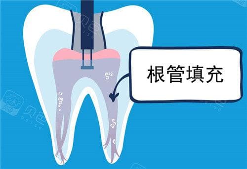 真相！根管治疗后的牙齿早晚要拔？成功根管的牙齿不需要，失败或再次感染可能要拔掉！