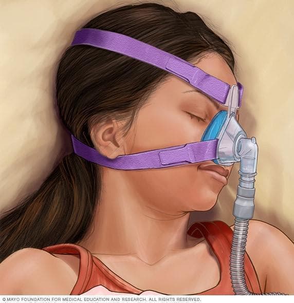 儿童阻塞性睡眠呼吸暂停