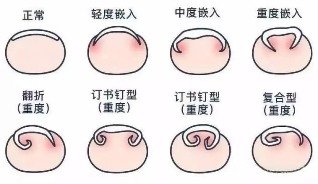 剪指甲强迫症：你以为的精致护理，正在制造血肉酷刑