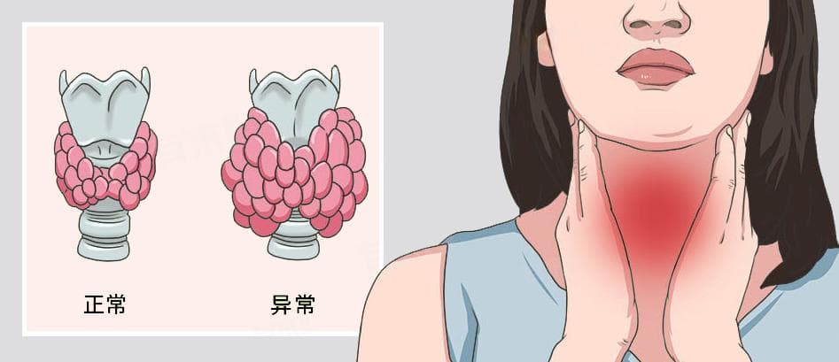 女性桥本甲状腺炎危害及日常注意事项