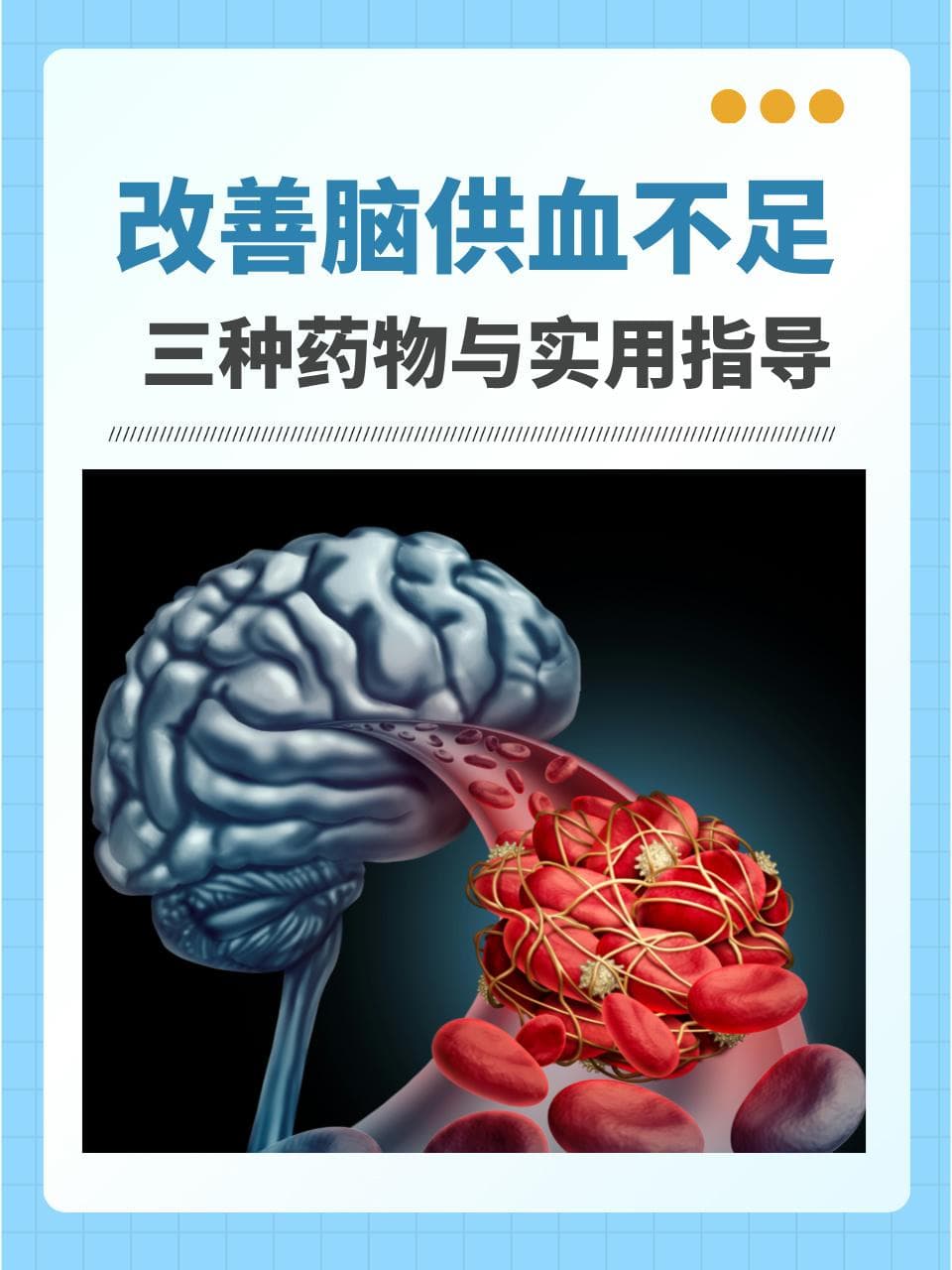 改善脑供血不足：三种药物与实用指导