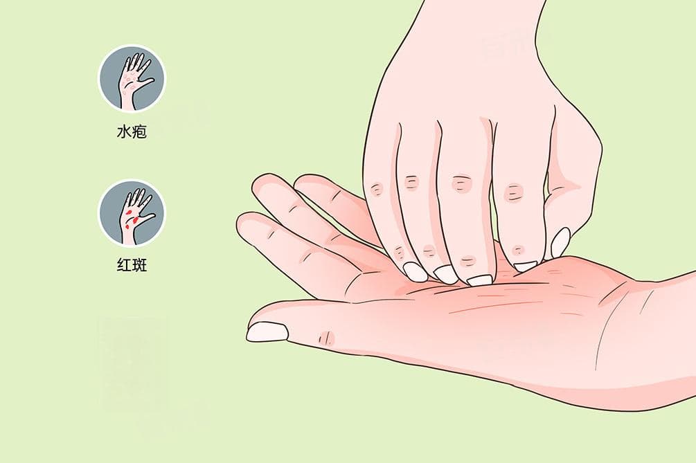 手心痒是怎么回事？五种常见原因及治疗方法