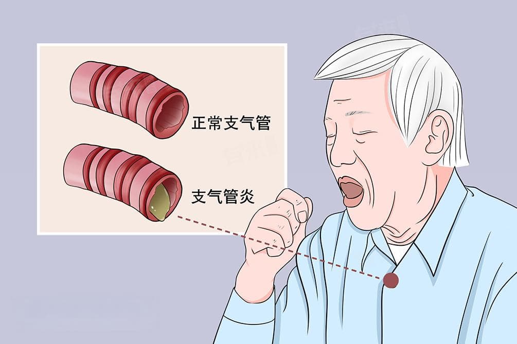 支气管炎咳嗽长期不愈怎么办？从病因到护理的全方位指南