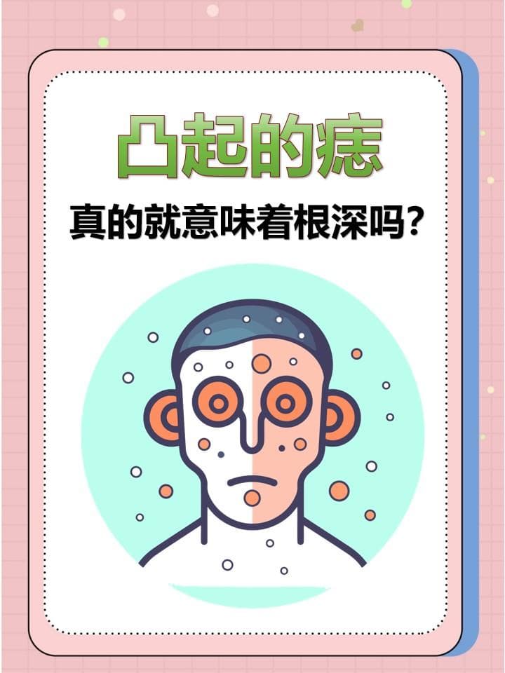 凸起的痣，真的就意味着根深吗？