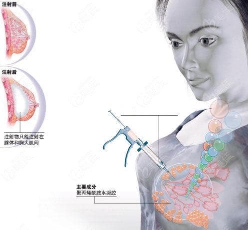 英捷尔法勒有必要取出！英捷尔法勒注射后出现肿块胀痛建议立刻取出