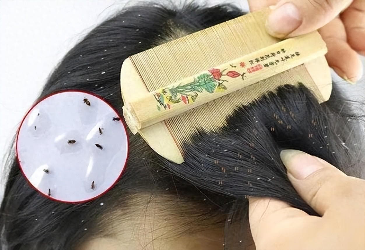虱子消失的秘密：与人类共存千年后为何骤然减少？