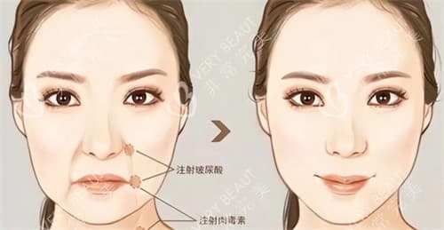 交联玻尿酸和非交联玻尿酸的区别：特点、用途及适用部位全解析
