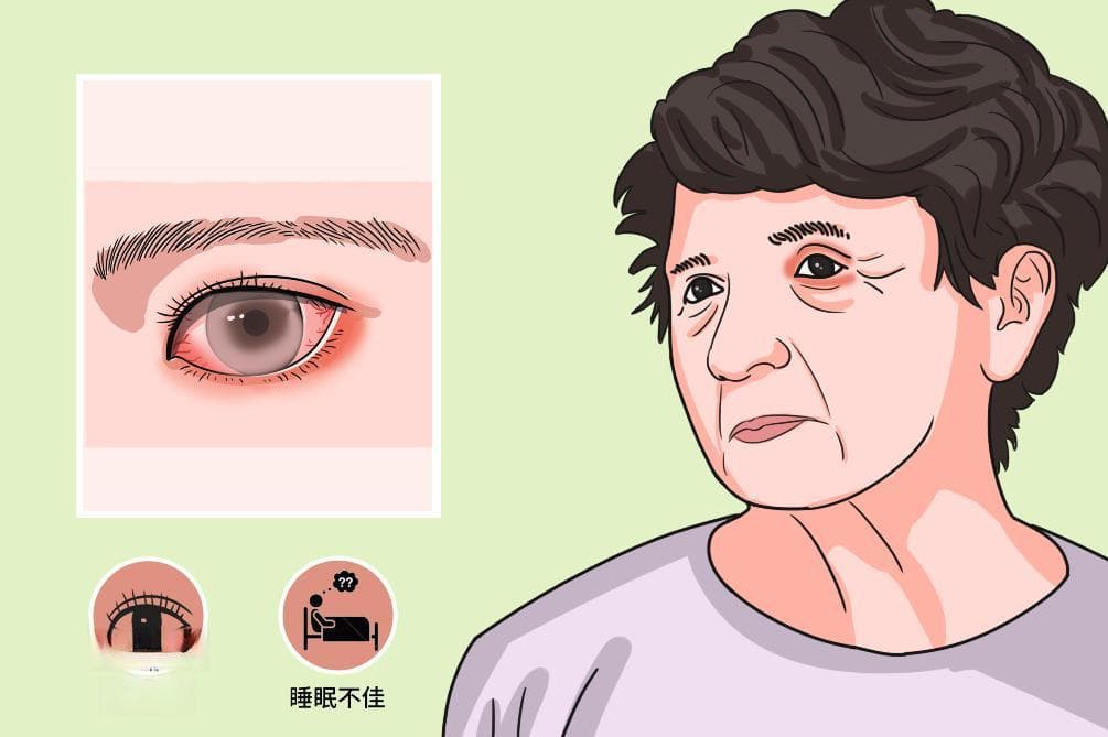 眼睑水肿的五种常见原因
